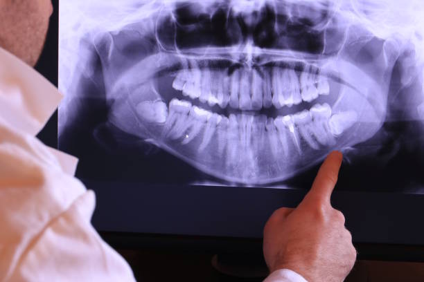 Best Knocked-Out Tooth (Avulsed Tooth) Treatment in Geistown, PA